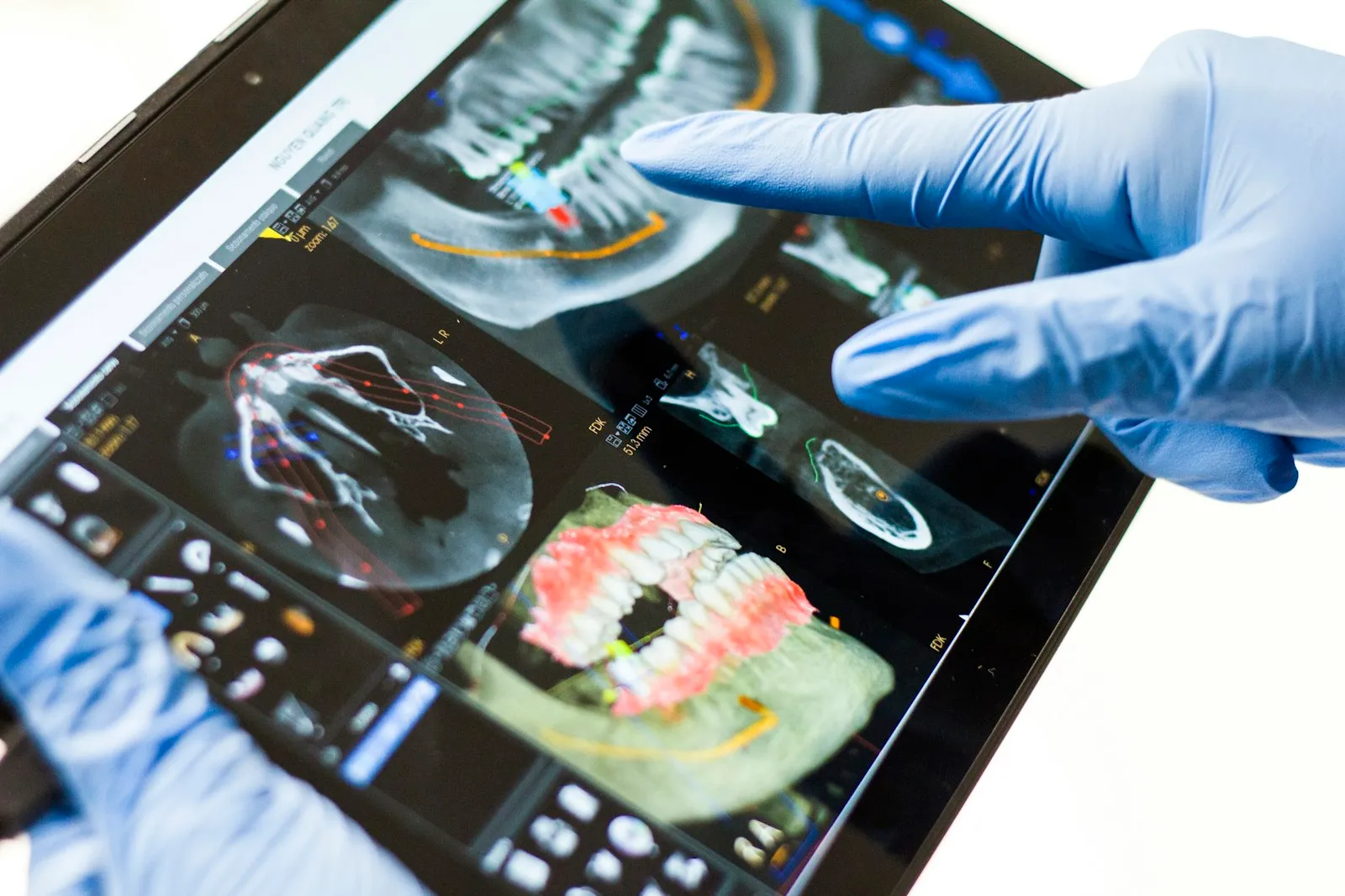 Dentist reviewing a 3D dental scan on a screen