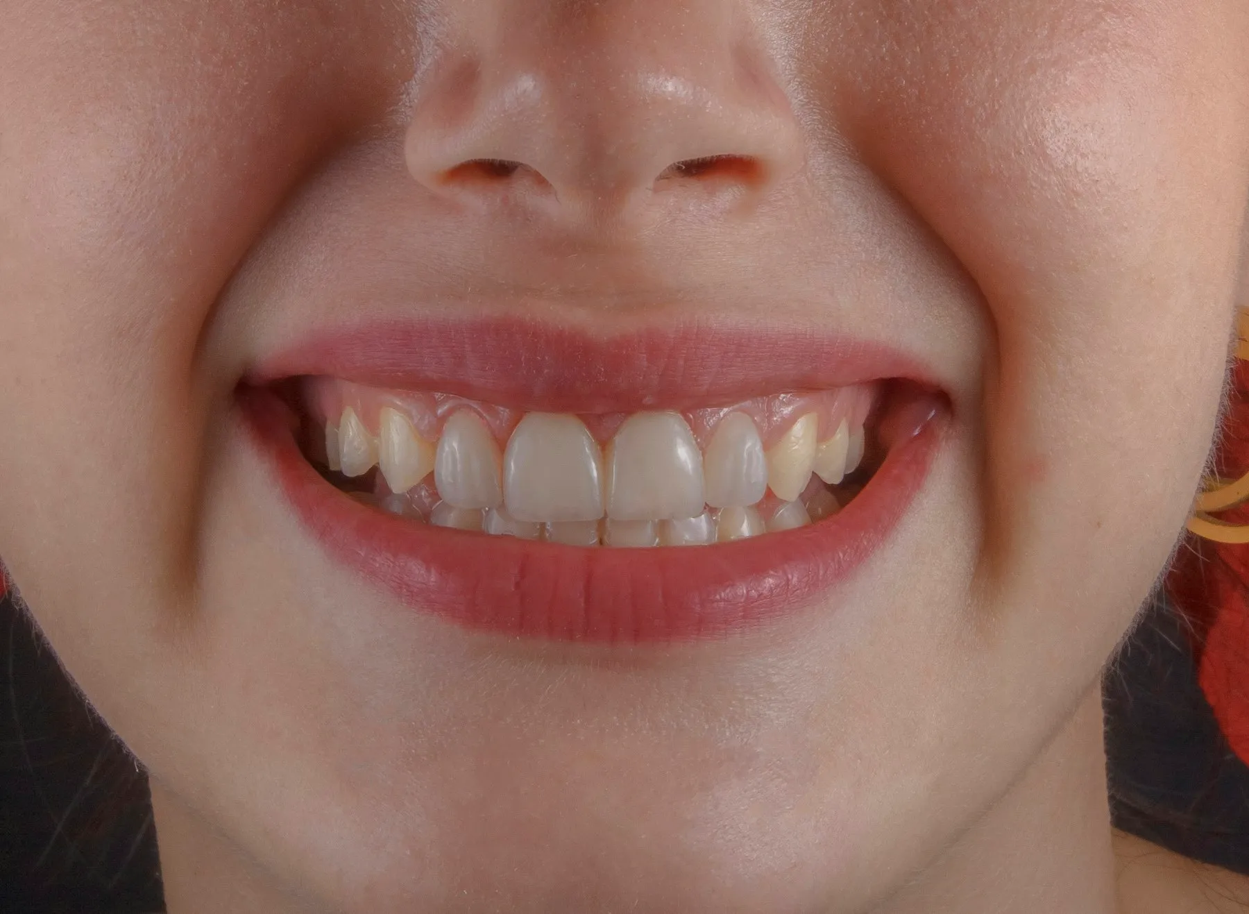 Close-up of a smile after whitening